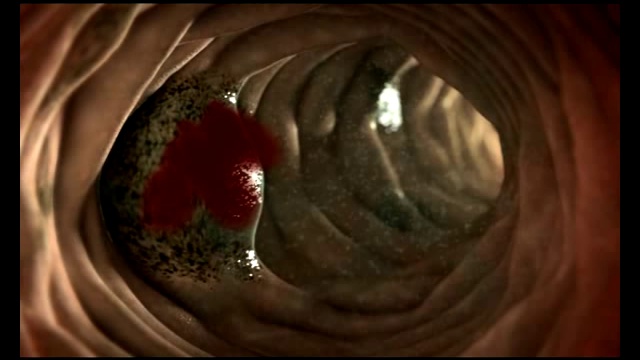 Алкоголь и кишечник