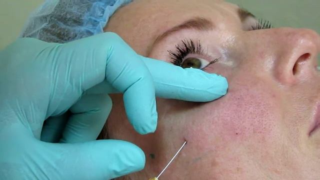 Обучение работе со скулой. Методика восстановления переорбитальной зоны. смотреть онлайн