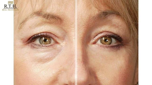 Малярные мешки. Косметологические методы борьбы.