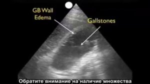 Порядок выполнения: ультразвуковое исследование желчного пузыря, часть 3 — холецистит