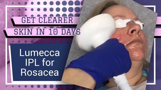 Clearer Skin In 10 Days With Lumecca