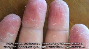 Облазит кожа на пальцах рук у ребенка — причины