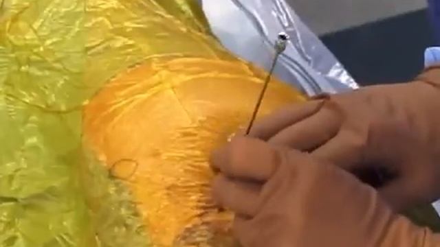 Артроскопия тазобедренного сустава (Hip Arthroscopy)