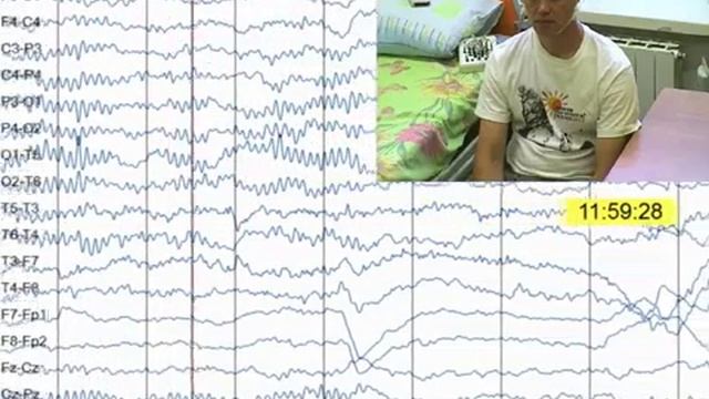 Пример видеозаписи электроэнцефалографа БИОЛА "Нейроскоп" смотреть онлайн