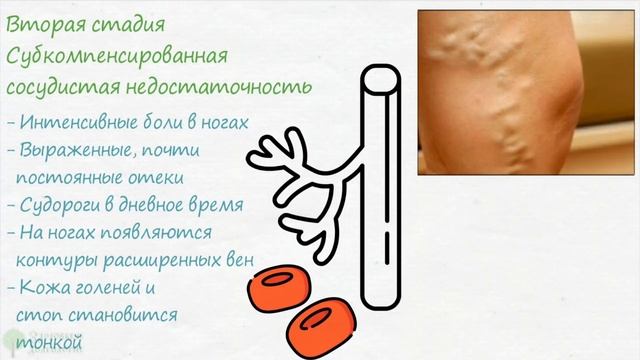 Чистые ножки и легкость! 3 простых народных средства от любой стадии варикоза смотреть онлайн