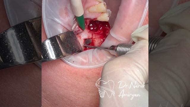 Открытый синус-лифтинг и направленная костная регенерация в области 15 зуба. смотреть онлайн