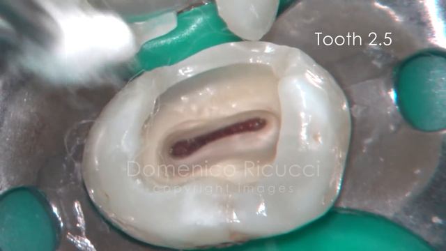 Tooth Cavity - Partial Pulpotomy Procedure (Healed Without a Root Canal!) - Dr. Ricucci смотреть онлайн