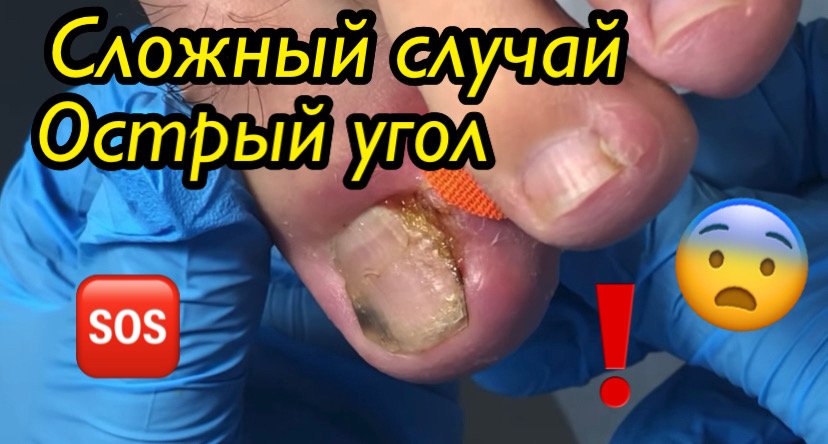 Сложный случай?? • Острый угол⚠️??? смотреть онлайн