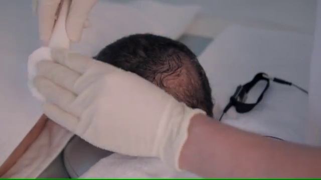 Fusion Mesotherapy - Fractional Meso Hair Treatment