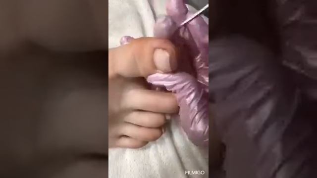 Неправильно обрезанный ноготок смотреть онлайн