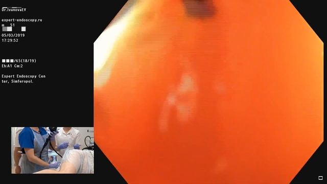 05Live Иванова ЕВ Экспертная Колоноскопия при язвенном колите смотреть онлайн