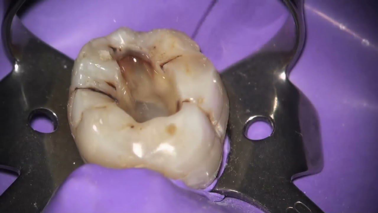 Обработка корневых каналов с использованием файлов ProTaper Gold®