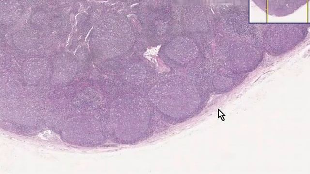 Lymph node Follicular hyperplasia смотреть онлайн
