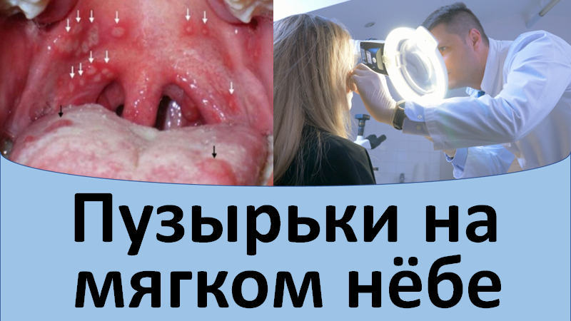 Пузырьки на мягком нёбе смотреть онлайн