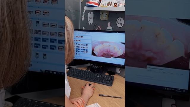 Реставрация 4 верхних передних зубов.