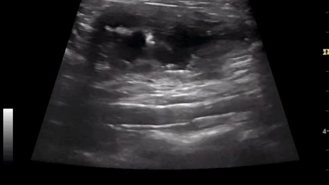 Частичная отслойка слизистой оболочки в мочевом пузыре у кота. смотреть онлайн