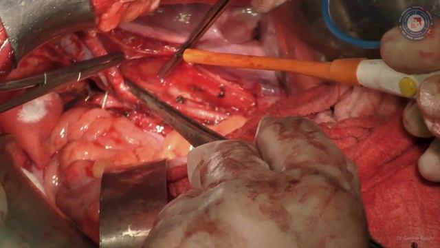 Pelvic lymph node dissection (PLND) смотреть онлайн