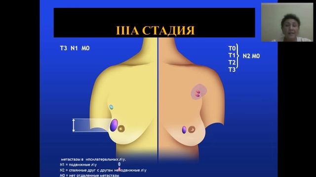 Рак молочной железы смотреть онлайн
