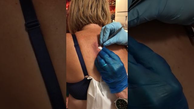 Infected Sebaceous Cyst - Day 41- Not Good - New Pain Dressing Change - Part 18 смотреть онлайн