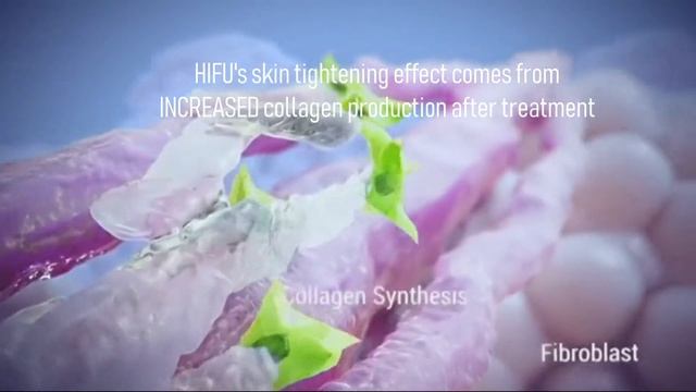 How HIFU works: Doublo Gold High-Intensity Focused Ultrasound Technology Principle смотреть онлайн