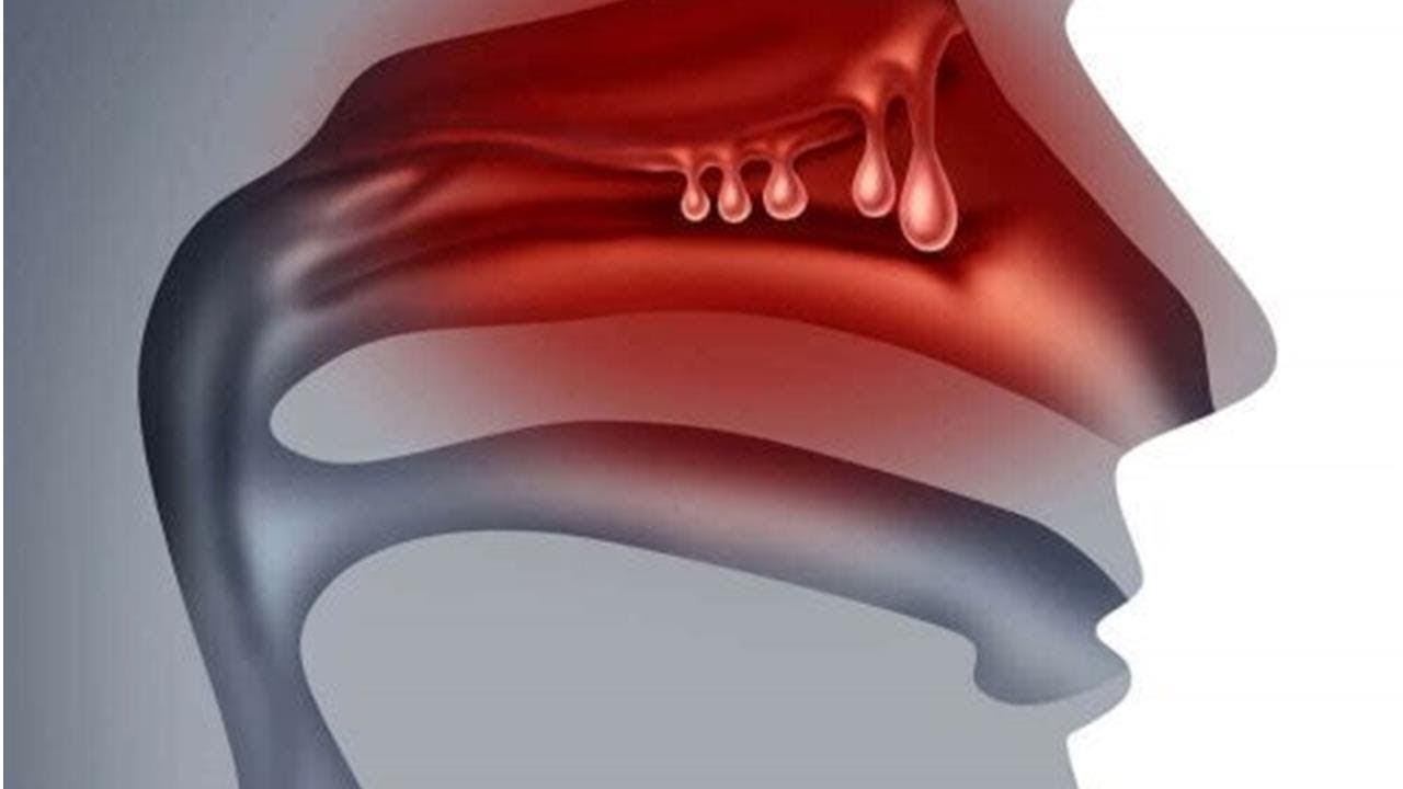 Острый ринит