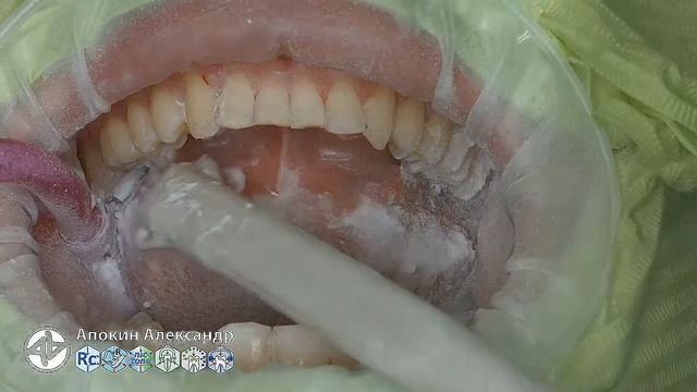 Professional oral hygiene -case 005 Acteon DTE Dentsply Coxo Floweis 3M KerrHawe (multistream) смотреть онлайн