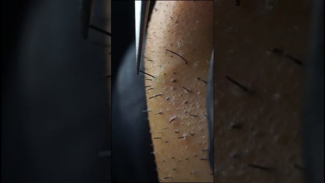 Пинцетом для удаления вросшей бороды for iPhone 2020/11/21 смотреть онлайн