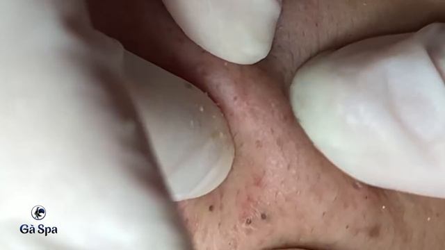 SIGNATURE SERVICE: Acnes Treatment (Ver.6) | Blackhead Popping смотреть онлайн
