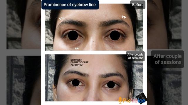 management of dropping eyebrow line смотреть онлайн