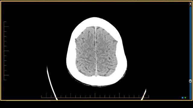 Retroclival Subdural Hematoma   MRI Online