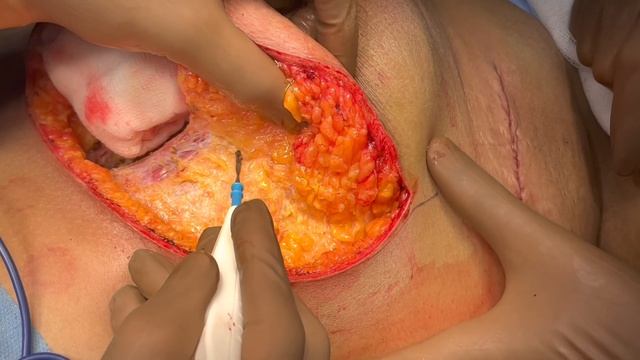Breast Conservative Surgery- V reduction Onco mammaplasty and Sentinel Node Biopsy смотреть онлайн