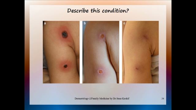 Dermatology-2, PROMETRIC, Mrcgp, Mcps Family Medicine,