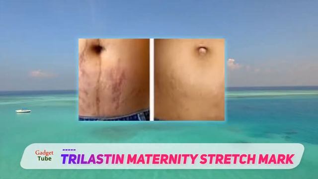 The Best Stretch Mark Cream - TriLASTIN Maternity Stretch Mark Review смотреть онлайн