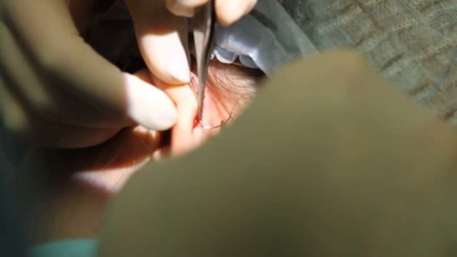 Отопластика. Профессор Орлов А.А./ Otoplasty. Professor Orlov Andrey смотреть онлайн