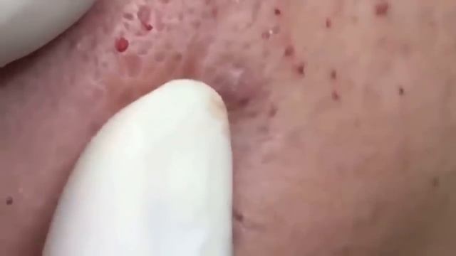 BESTПРЫЩ / КОВЫРЯЕТ ЗАСОХШИЕ ЧЕРНЫЕ ТОЧКИ