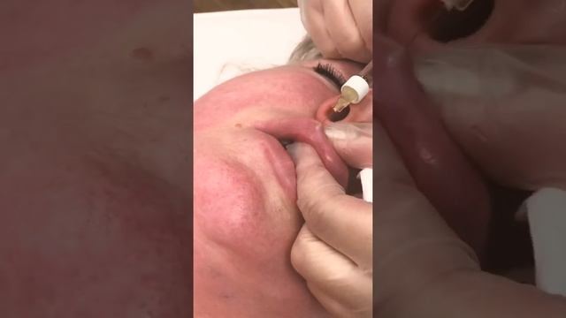 Коррекция возрастных губ смотреть онлайн