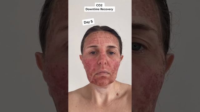 CO2 Fractional Laser: Recovery Day By Day