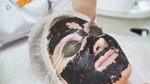 Лазерный карбоновый пилинг. Очищение и омоложение кожи. Лечение акне. смотреть онлайн