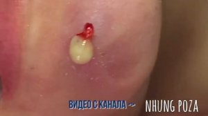 Удаление гноя