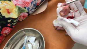 УДАЛЕНИЕ НОГТЯ НА РУКЕ