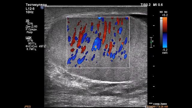 Острый орхоэпидидимит смотреть онлайн