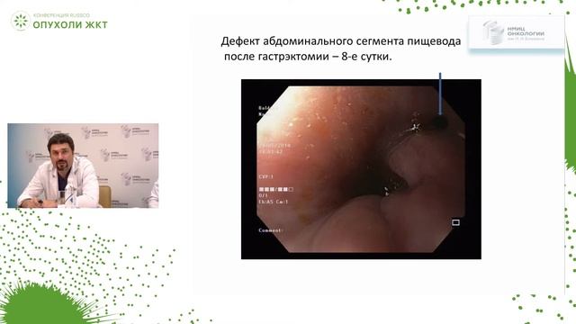 Опыт применения VAC-системы при несостоятельности пищеводно-кишечного анастомоза смотреть онлайн