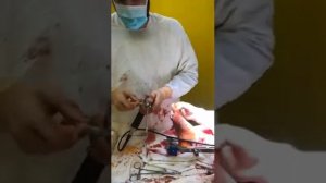 Артродез голеностопного и таранно-пяточного сустава