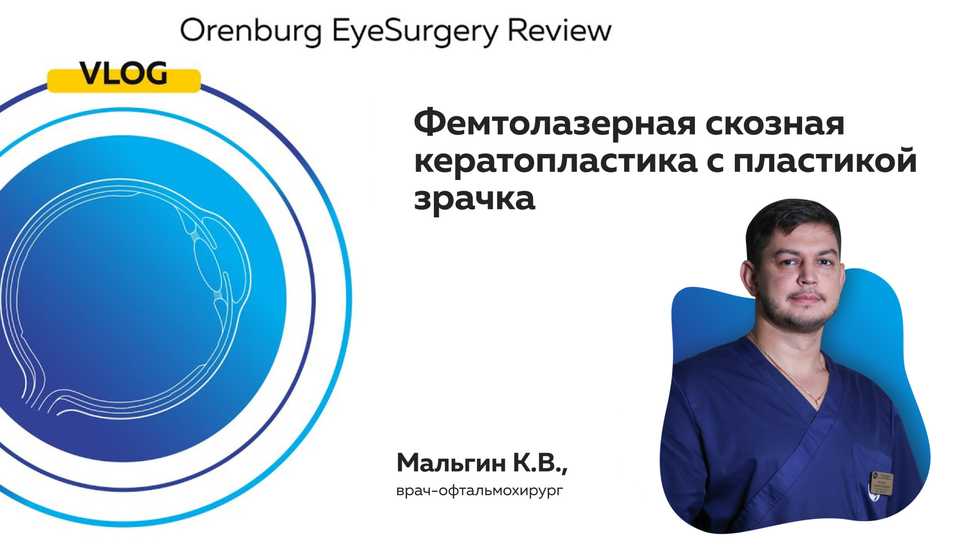 Фемтолазерная скозная кератопластика с пластикой зрачка