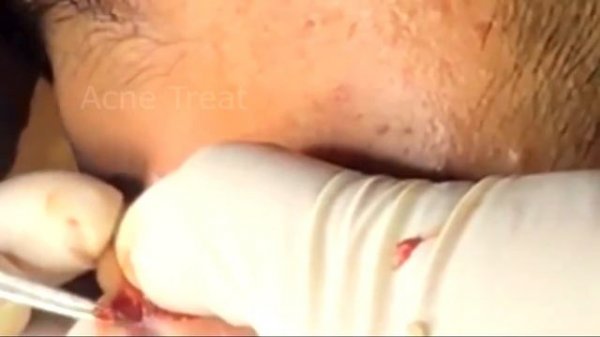 Pimple popping | Cyst popping | Кистозное извлечение | Прыщи от прыщей удаляют дома