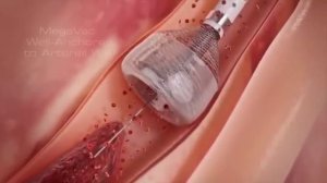 Удаление тромбов из артерии вакуумным методом.