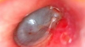 Краевая перфорация барабанной перепонки