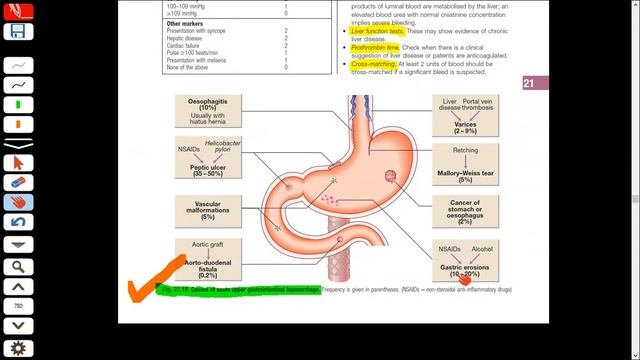 GIT Bleeding from Davidson | Medicine | Urdu/Hindi | Medical Globe E-learning смотреть онлайн