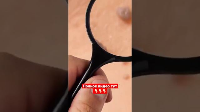 Как избавиться от папиллом? #бородавки #папилломы смотреть онлайн