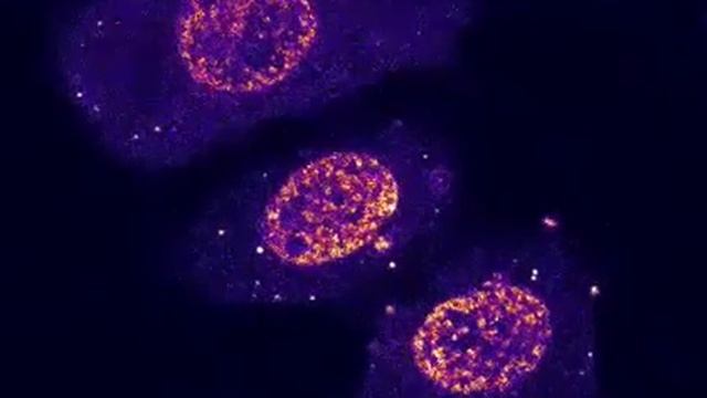 Activation of a transcription factor in basal cell carcinoma смотреть онлайн
